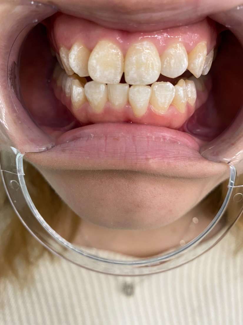 歯のホワイトスポットとは？